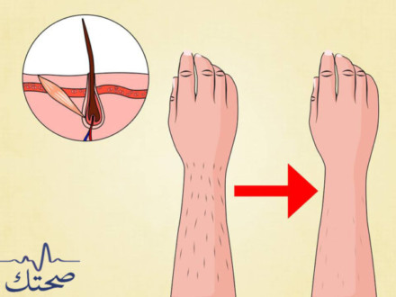 طريقة ازالة الشعر من الجسم نهائيا و وصفة لازالة شعر الوجه