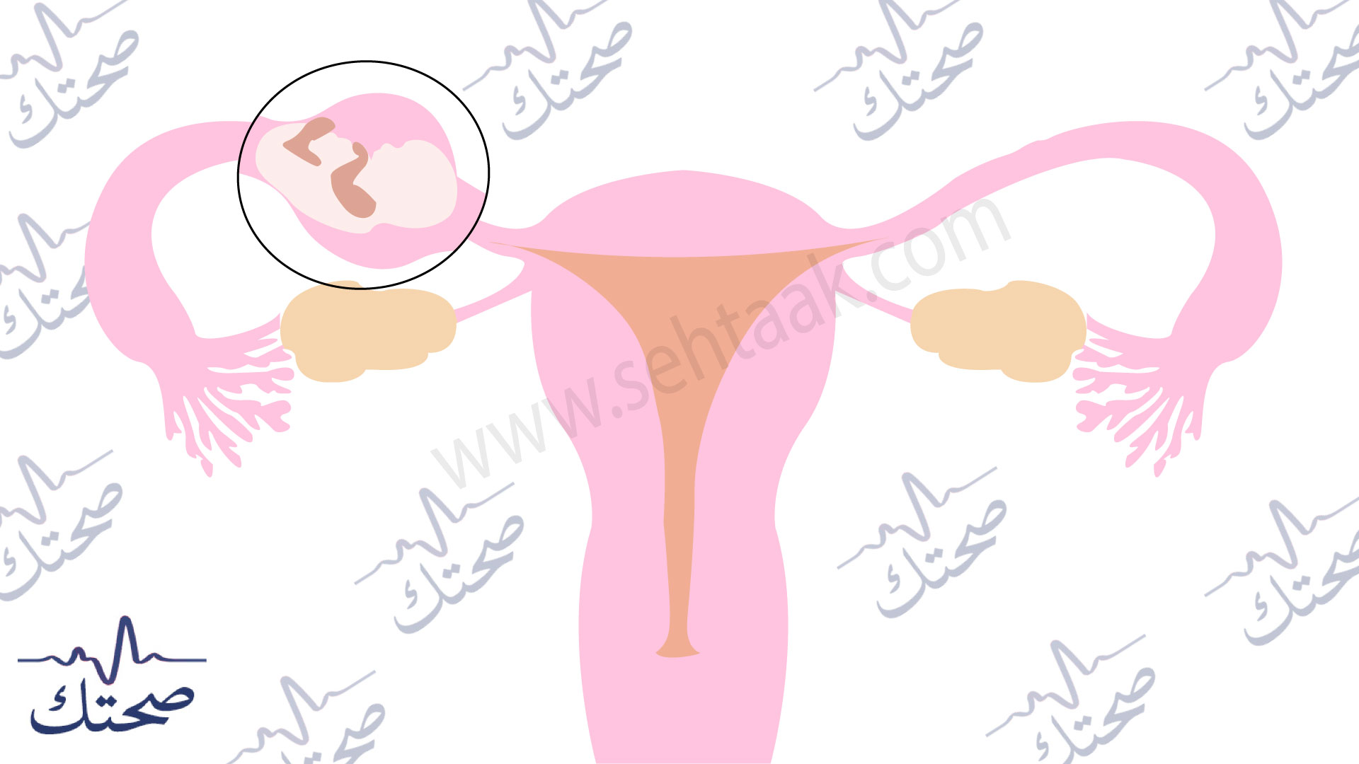 اعراض الحمل خارج الرحم - علامات الحمل خارج الرحم - علامات الحمل - اعراض الحمل