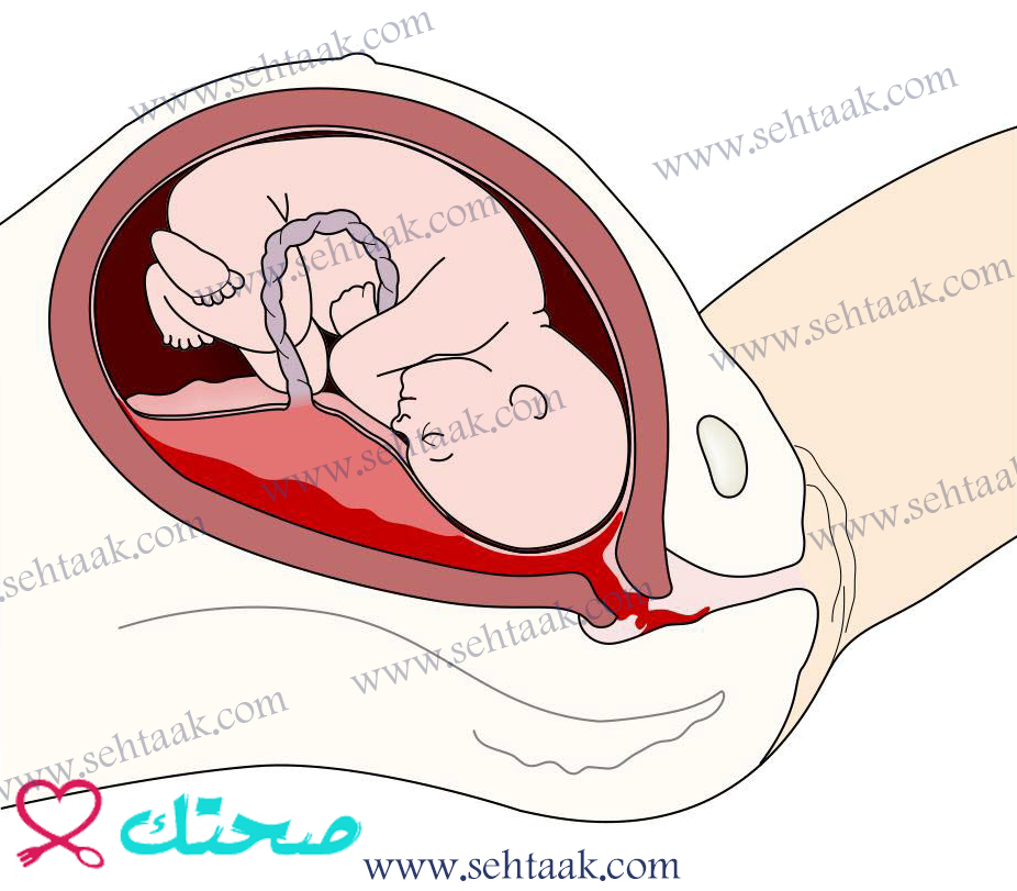 متى تتكون المشيمة_المشيمة النازلة_ما هي المشيمة_متى تظهر المشيمة في السونار_متى يلتئم انفصال المشيمة_متى ترتفع المشيمه عند الحامل_كيف ارفع المشيمه النازله